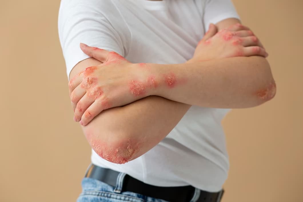 Psorijatični artritis iskustva