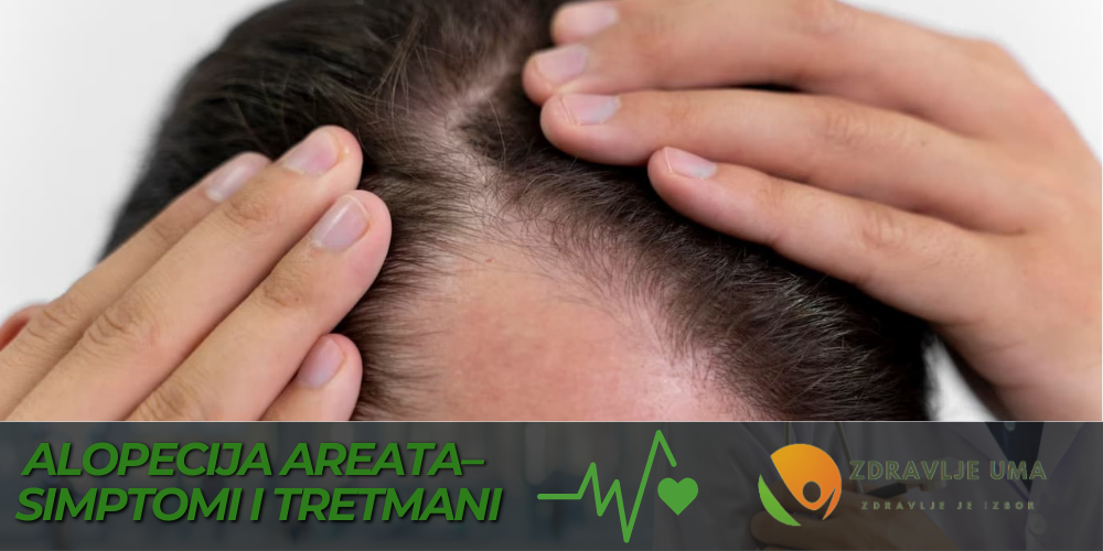 Alopecija Areata iskustva