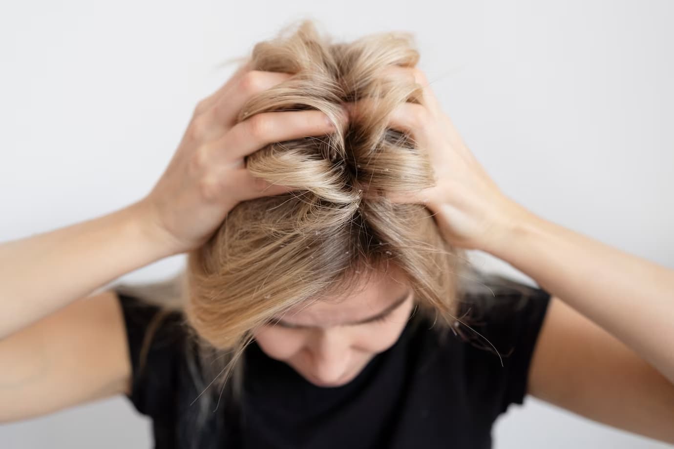 Seboreični dermatitis Iskustva