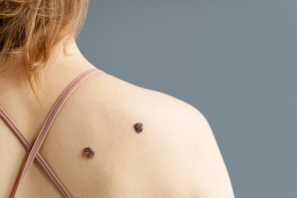 Simptomi bolesti melanoma