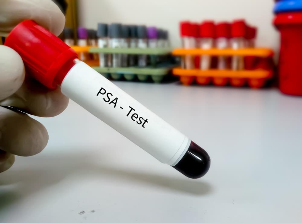 Uloga PSA testa