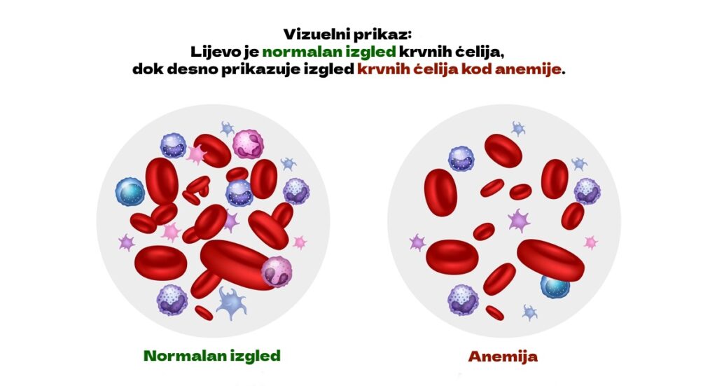 Šta je anemija